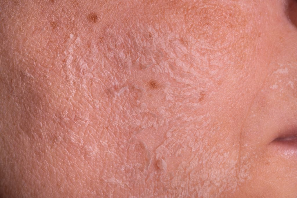 Close-up of dry, flaky facial skin highlighting skin barrier breakdown and the need for hydration and cellular renewal
